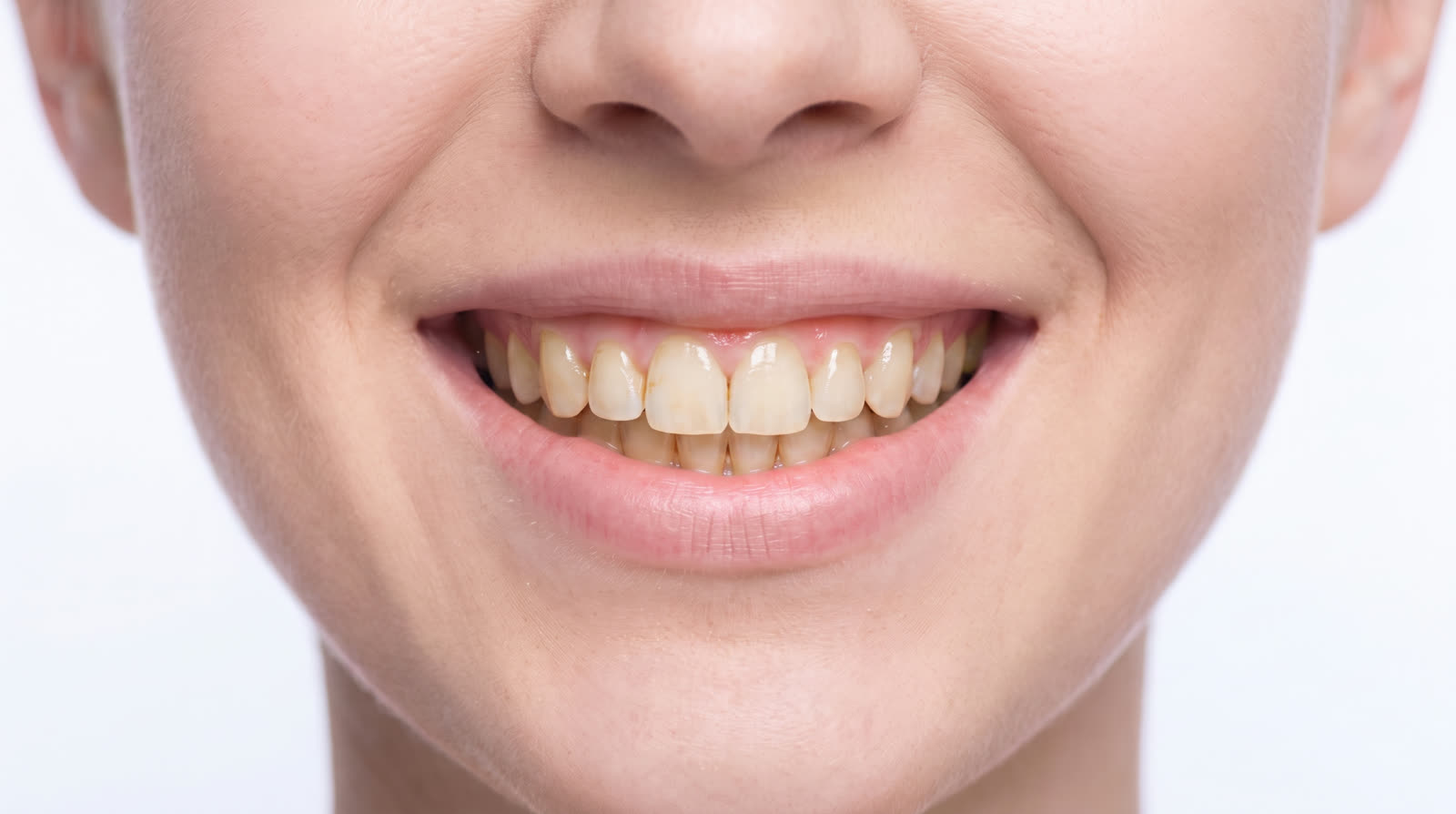 Smile before whitening — conceptual visualisation